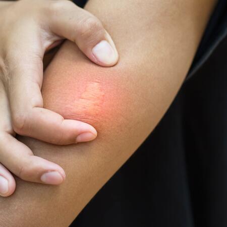 Nahaufnahme eines Bienenstichs am Oberarm