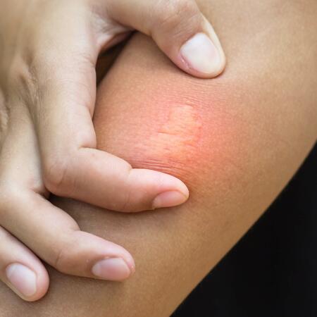 Nahaufnahme eines Bienenstichs am Oberarm