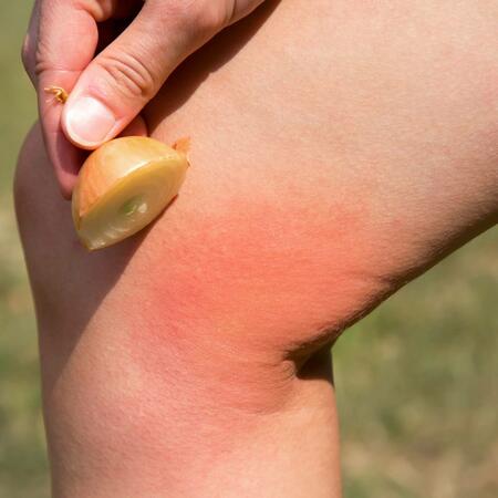 Behandlung eines Insektenstiches mit einer Zwiebel